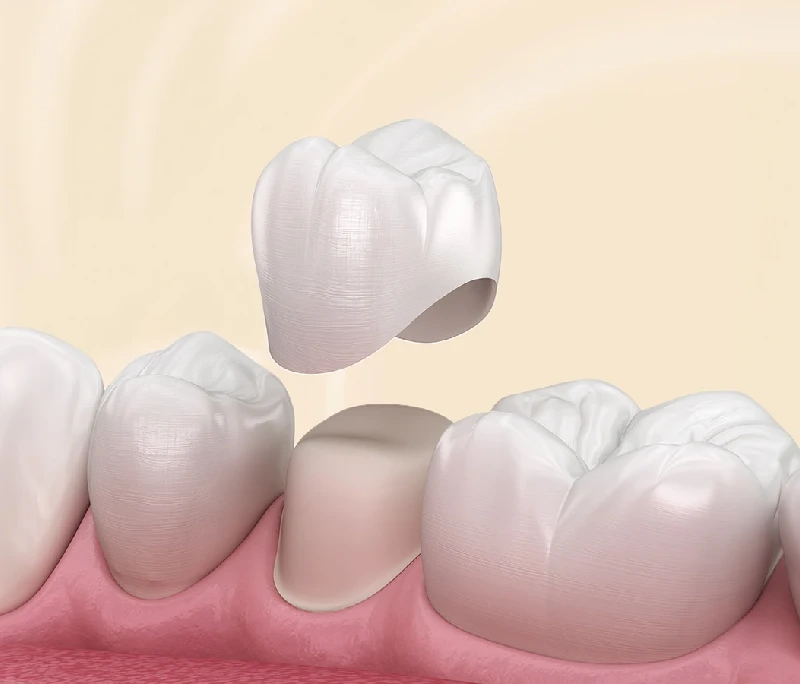 Bọc răng sứ phù hợp với các trường hợp răng bị tổn thương nặng